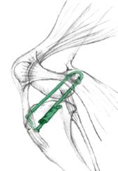 Lateral Suture